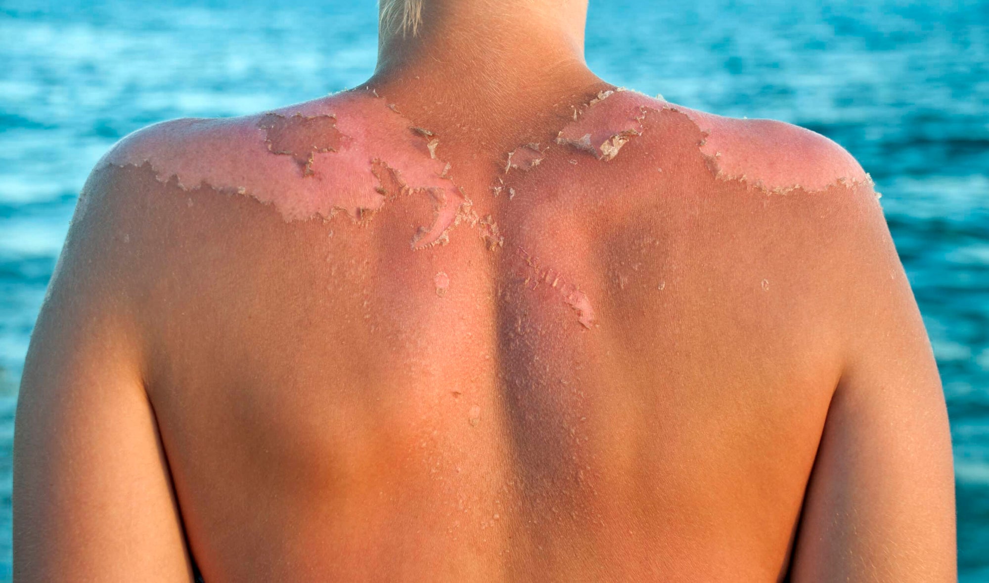 The Effects of the Sun on Our Skin